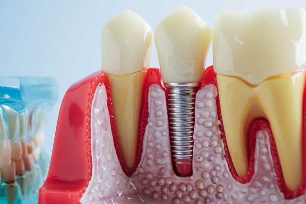 Dental Implants Hattiesburg