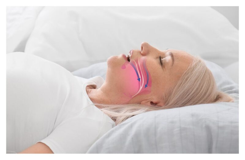 Vivos Seep Apnea Treatment