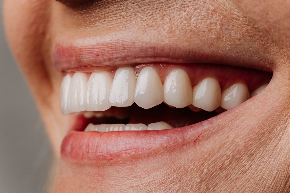 Dental Veneers Hattiesburg
